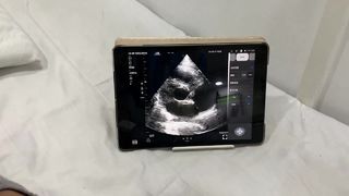 Беспроводной ультразвуковой датчик с двойной головкой для кардиологии и POCUS